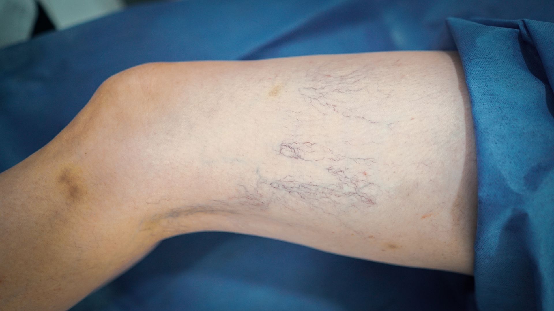 Várices enfermedad de la circulación